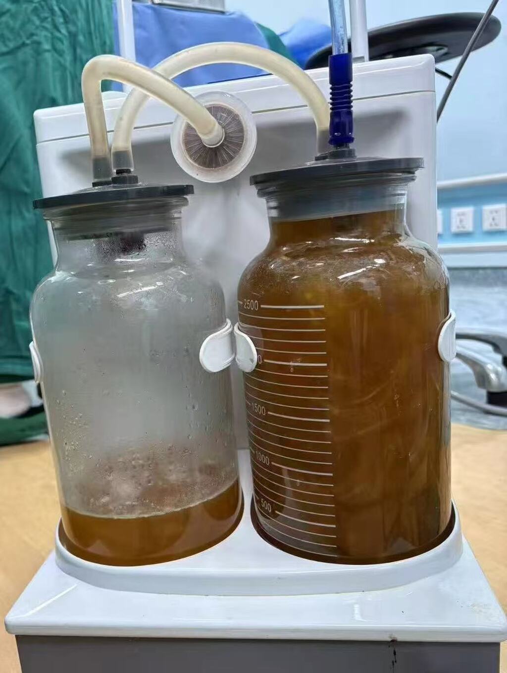 医生从女孩卵巢囊肿中抽出的囊液。 重庆市中医院供图