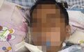 3岁男童扁桃体手术10天后脑死亡，当地卫健局已介入